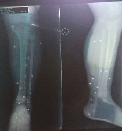 Bé 4 tuổi bị găm 15 mảnh đạn: Đủ dấu hiệu Cố ý gây thương tích